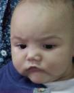 CHILD WITH CYSTIC TUMOR